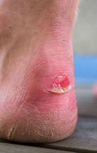 Can Blisters on the Feet Become Infected?