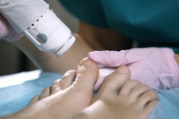 Why Laser Treatment for Fungal Nails Can Be Effective