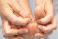 Origins and Symptoms Revealed for Athlete’s Foot
