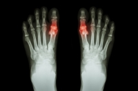 Exploring the Link Between Diet and Gout