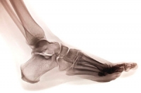 Explanation of a Stress Fracture