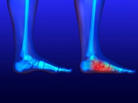 What are Flat Feet and How is It Treated?